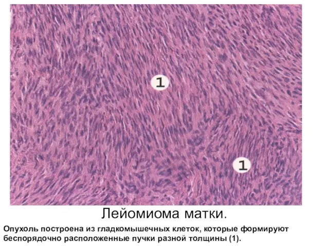 Лейомиома матки. Опухоль построена из гладкомышечных клеток, которые формируют беспорядочно расположенные пучки разной толщины (1).