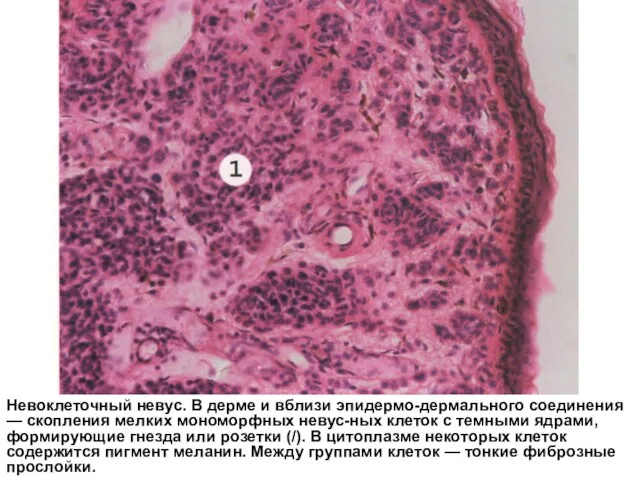 Невоклеточный невус. В дерме и вблизи эпидермо-дермального соединения — скопления мелких мономорфных
