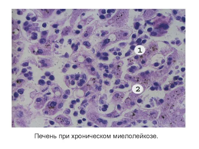 Печень при хроническом миелолейкозе.