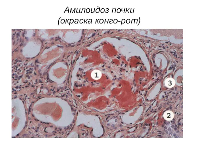 Амилоидоз почки (окраска конго-рот)