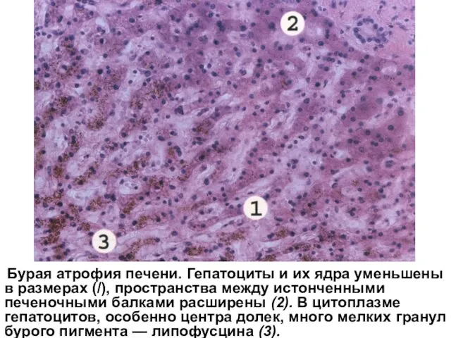 Бурая атрофия печени. Гепатоциты и их ядра уменьшены в размерах (/), пространства