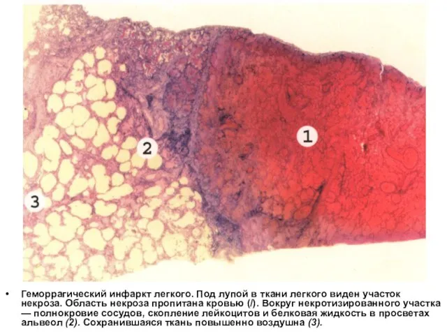 Геморрагический инфаркт легкого. Под лупой в ткани легкого виден участок некроза. Область