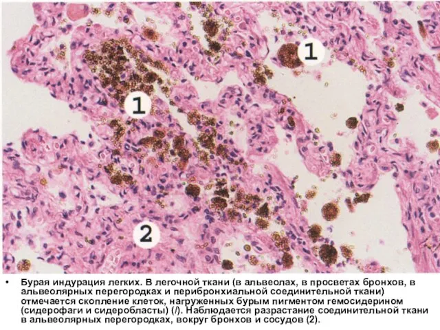 Бурая индурация легких. В легочной ткани (в альвеолах, в просветах бронхов, в