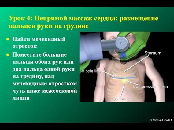 Урок 4: Непрямой массаж сердца: размещение пальцев руки на грудине Найти мечевидный