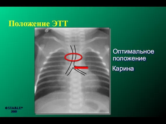 Положение ЭТТ Карина Оптимальное положение © S.T.A.B.L.E.® 2001