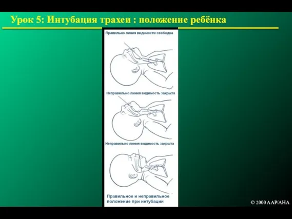 Урок 5: Интубация трахеи : положение ребёнка © 2000 AAP/AHA