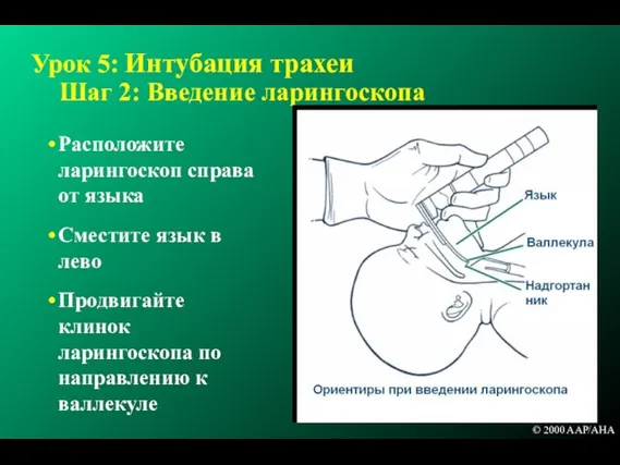 Урок 5: Интубация трахеи Шаг 2: Введение ларингоскопа Расположите ларингоскоп справа от