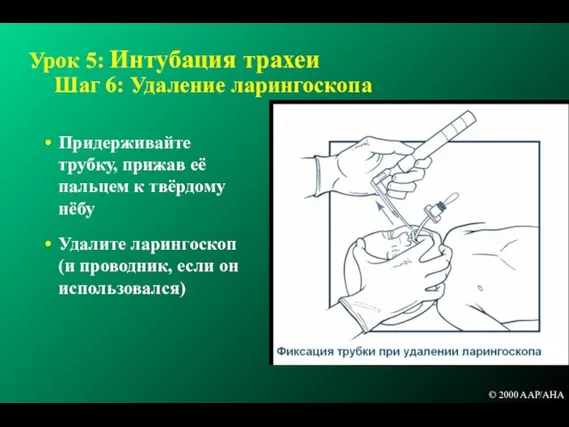 Урок 5: Интубация трахеи Шаг 6: Удаление ларингоскопа Придерживайте трубку, прижав её