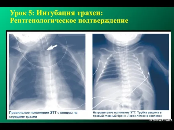 Урок 5: Интубация трахеи: Рентгенологическое подтверждение © 2000 AAP/AHA © 2000 AAP/AHA