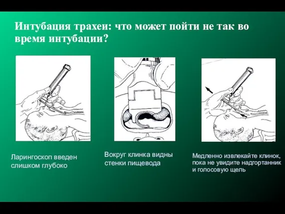 Интубация трахеи: что может пойти не так во время интубации? Ларингоскоп введен