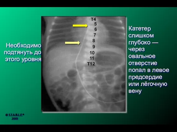 Катетер слишком глубоко — через овальное отверстие попал в левое предсердие или