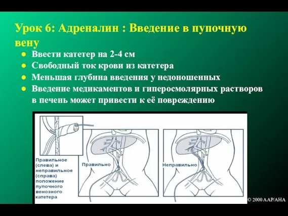 Урок 6: Адреналин : Введение в пупочную вену Ввести катетер на 2-4