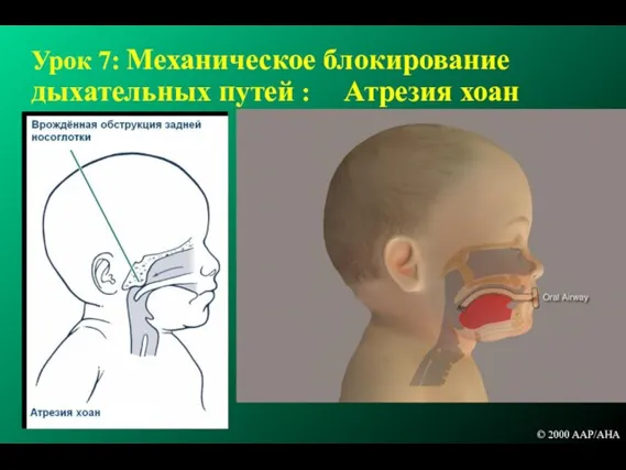 Урок 7: Механическое блокирование дыхательных путей : Атрезия хоан © 2000 AAP/AHA