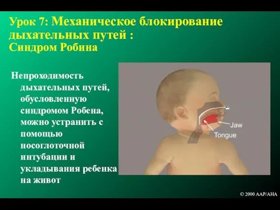 Урок 7: Механическое блокирование дыхательных путей : Синдром Робина Непроходимость дыхательных путей,