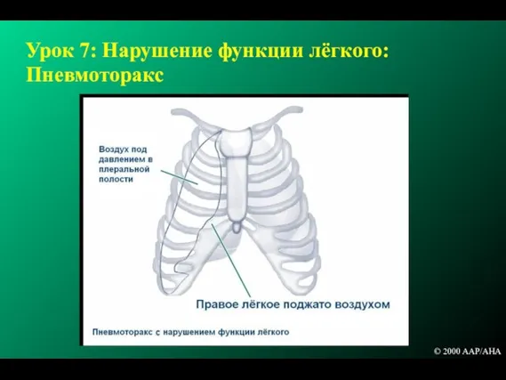 Урок 7: Нарушение функции лёгкого: Пневмоторакс © 2000 AAP/AHA