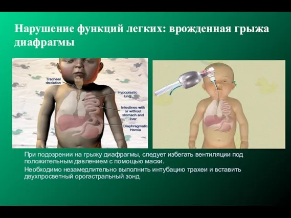 Нарушение функций легких: врожденная грыжа диафрагмы При подозрении на грыжу диафрагмы, следует