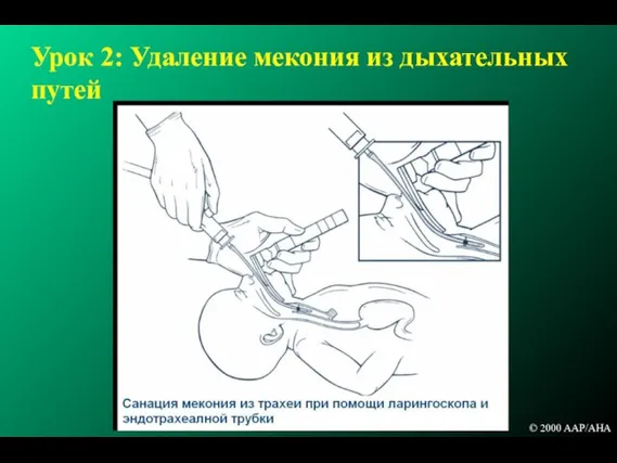 Урок 2: Удаление мекония из дыхательных путей © 2000 AAP/AHA