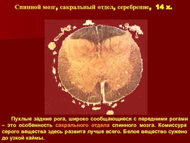 Пухлые задние рога, широко сообщающиеся с передними рогами – это особенность сакрального