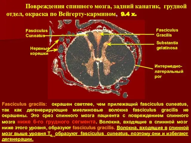 Повреждения спинного мозга, задний канатик, грудной отдел, окраска по Вейгерту-кармином, 9.4 x.