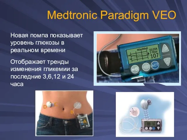 Medtronic Paradigm VEO Новая помпа показывает уровень глюкозы в реальном времени Отображает
