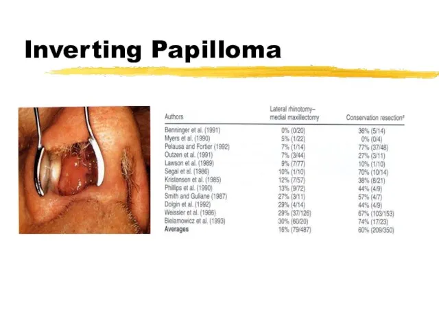 Inverting Papilloma