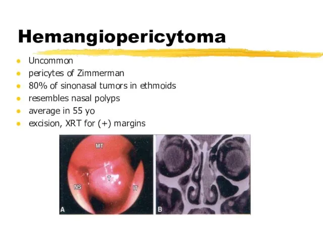 Hemangiopericytoma Uncommon pericytes of Zimmerman 80% of sinonasal tumors in ethmoids resembles