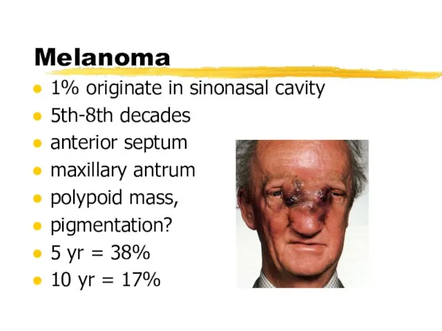 Melanoma 1% originate in sinonasal cavity 5th-8th decades anterior septum maxillary antrum