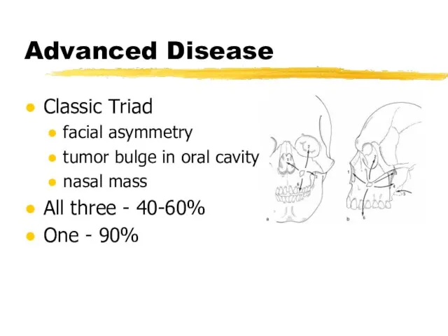 Advanced Disease Classic Triad facial asymmetry tumor bulge in oral cavity nasal