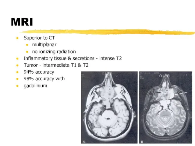 MRI Superior to CT multiplanar no ionizing radiation Inflammatory tissue & secretions