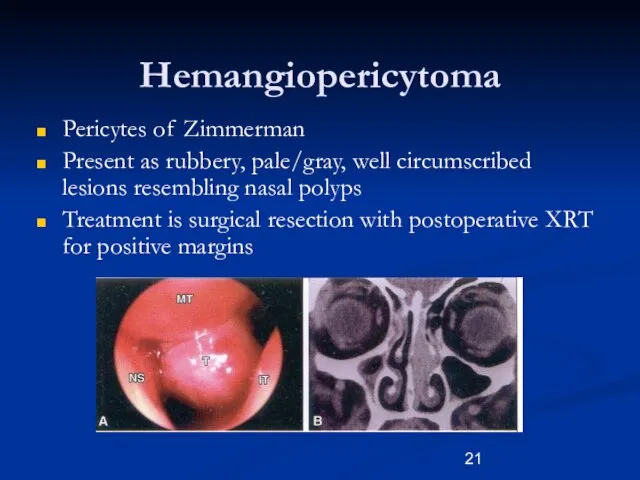 Hemangiopericytoma Pericytes of Zimmerman Present as rubbery, pale/gray, well circumscribed lesions resembling