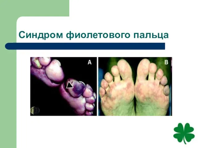 Синдром фиолетового пальца