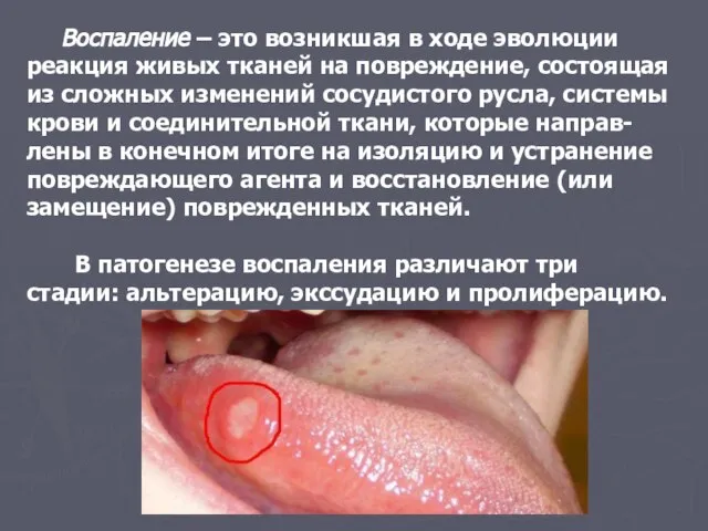 Воспаление – это возникшая в ходе эволюции реакция живых тканей на повреждение,