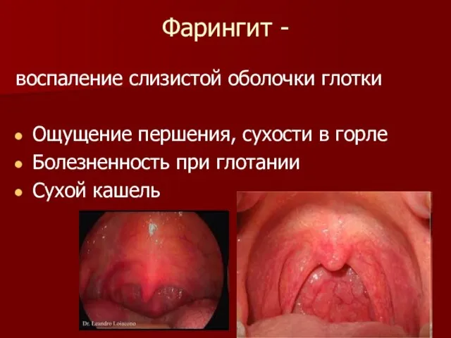 Фарингит - воспаление слизистой оболочки глотки Ощущение першения, сухости в горле Болезненность при глотании Сухой кашель