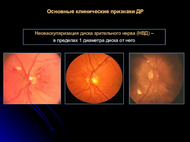 Основные клинические признаки ДР Неоваскуляризация диска зрительного нерва (НВД) – в пределах