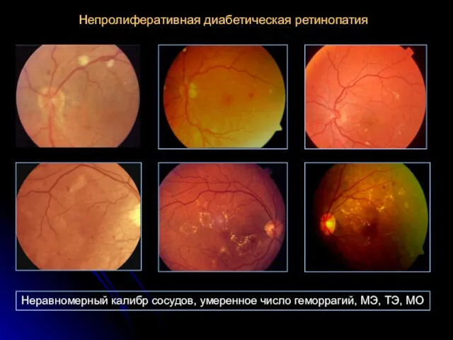 Неравномерный калибр сосудов, умеренное число геморрагий, МЭ, ТЭ, МО Непролиферативная диабетическая ретинопатия