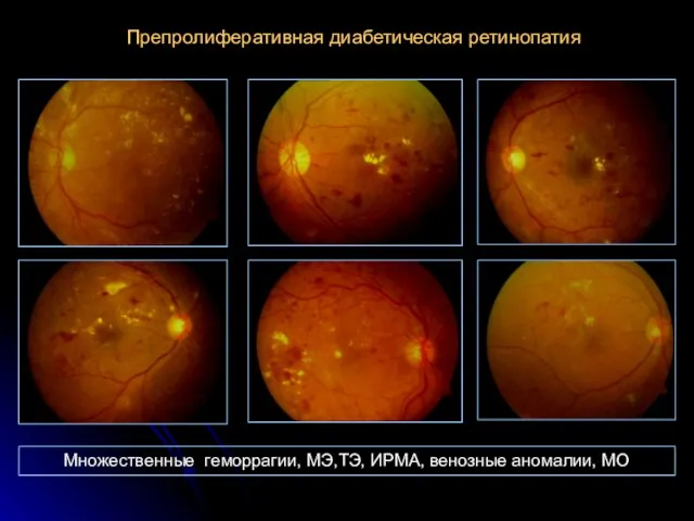 Препролиферативная диабетическая ретинопатия Множественные геморрагии, МЭ,ТЭ, ИРМА, венозные аномалии, МО