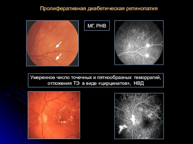 Пролиферативная диабетическая ретинопатия МГ, РНВ Умеренное число точечных и пятнообразных геморрагий, отложения