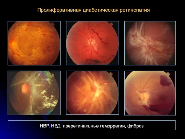 Пролиферативная диабетическая ретинопатия НВР, НВД, преретинальные геморрагии, фиброз