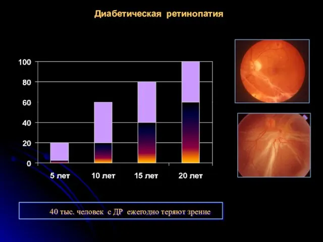 Диабетическая ретинопатия 40 тыс. человек с ДР ежегодно теряют зрение