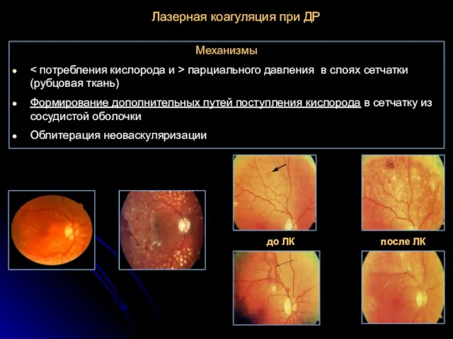 Лазерная коагуляция при ДР Механизмы парциального давления в слоях сетчатки (рубцовая ткань)