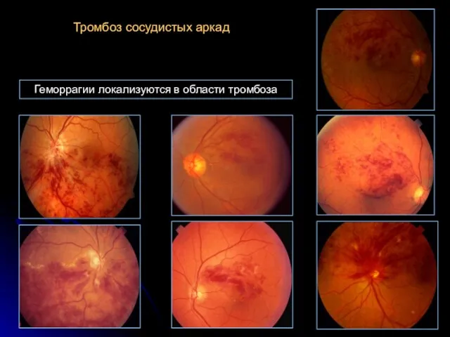 Тромбоз сосудистых аркад Геморрагии локализуются в области тромбоза