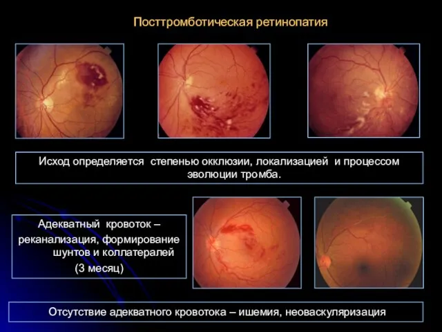 Посттромботическая ретинопатия Исход определяется степенью окклюзии, локализацией и процессом эволюции тромба. Адекватный