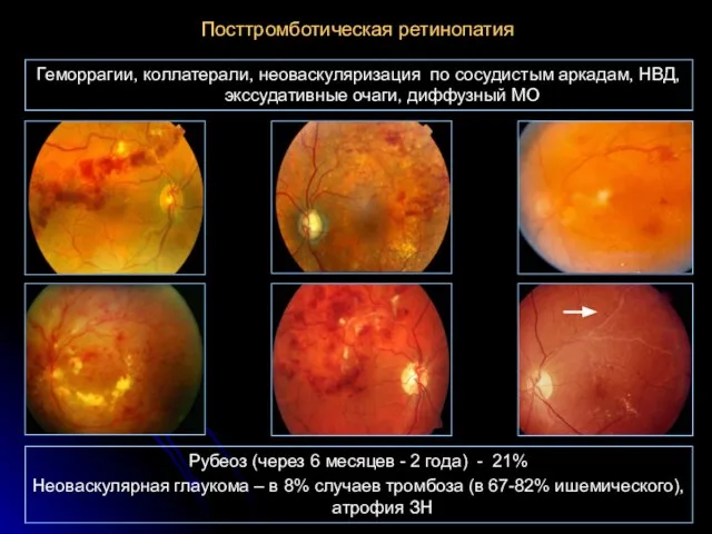 Посттромботическая ретинопатия Геморрагии, коллатерали, неоваскуляризация по сосудистым аркадам, НВД, экссудативные очаги, диффузный