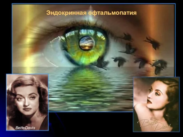 Эндокринная офтальмопатия BetteDavis