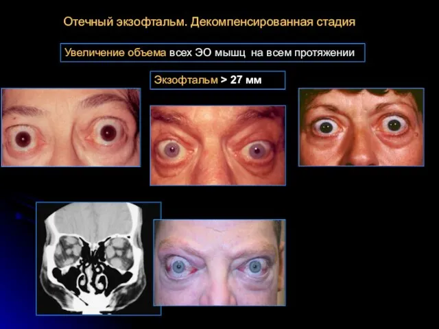 Экзофтальм > 27 мм Увеличение объема всех ЭО мышц на всем протяжении Отечный экзофтальм. Декомпенсированная стадия