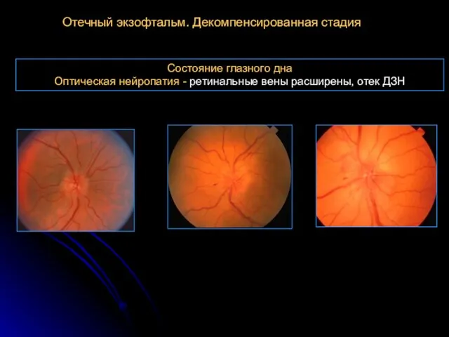 Состояние глазного дна Оптическая нейропатия - ретинальные вены расширены, отек ДЗН Отечный экзофтальм. Декомпенсированная стадия