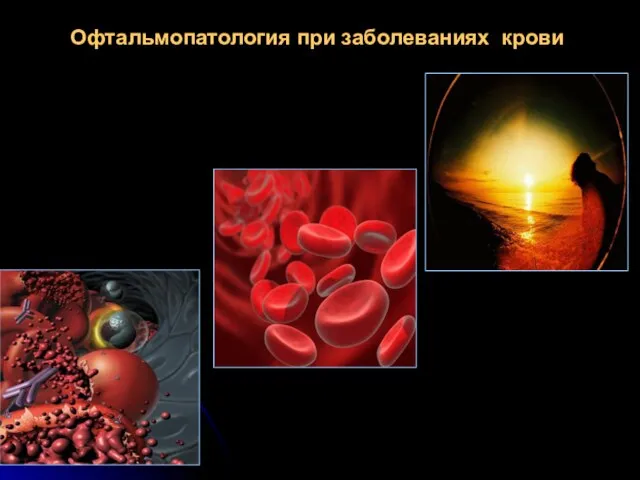 Офтальмопатология при заболеваниях крови