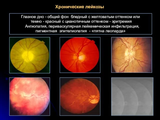 Хронические лейкозы Глазное дно - общий фон бледный с желтоватым оттенком или