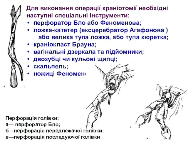 Для виконання операції краніотомії необхідні наступні спеціальні інструменти: перфоратор Бло або Феноменова;