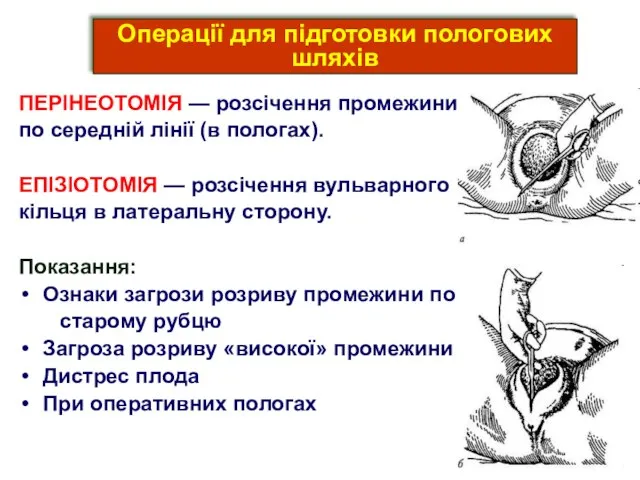 ПЕРІНЕОТОМІЯ — розсічення промежини по середній лінії (в пологах). ЕПІЗІОТОМІЯ — розсічення